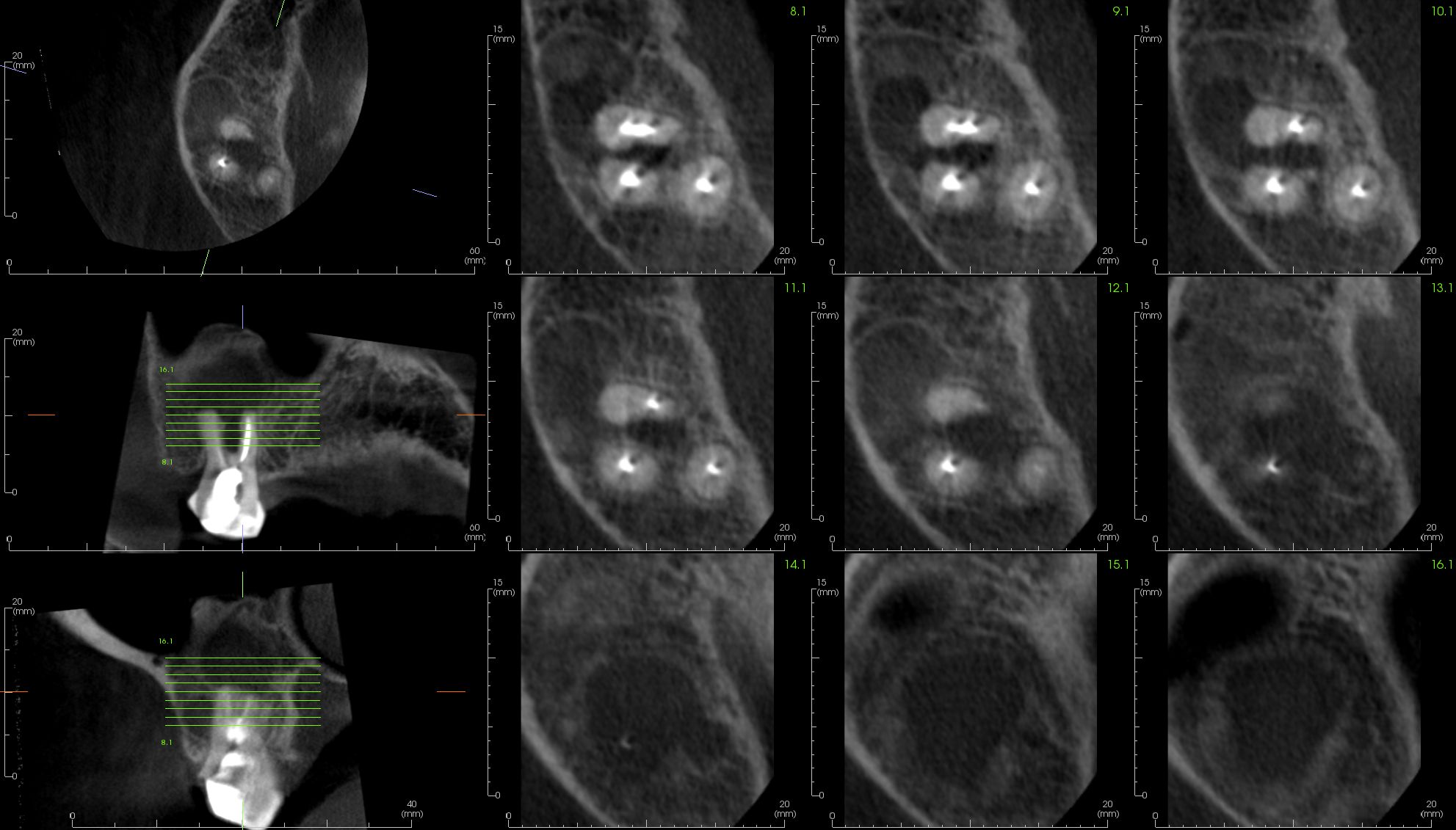 case-3.3-Endo-axial-views_2