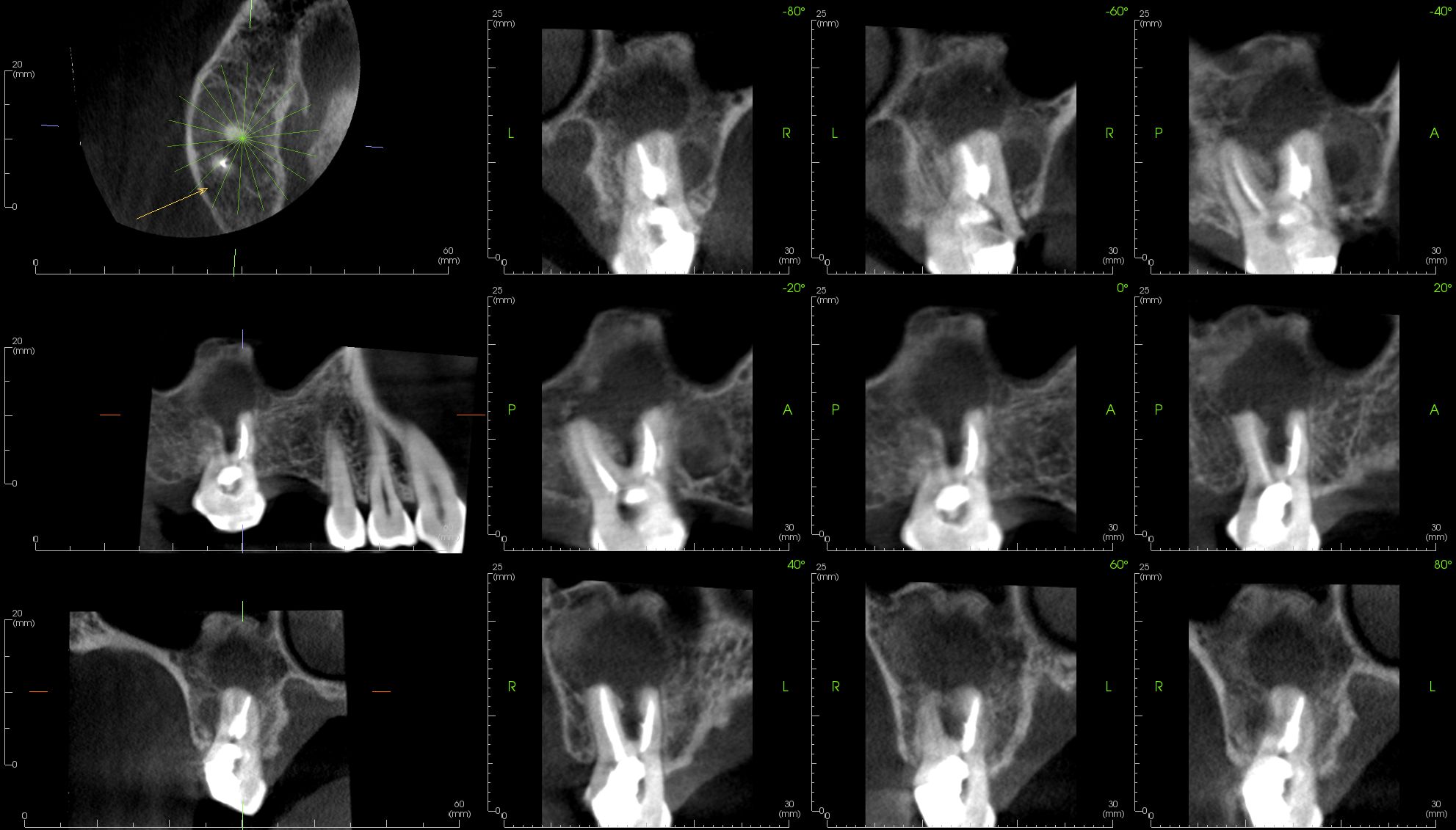 case-3.4-Endo-lateral-views_4