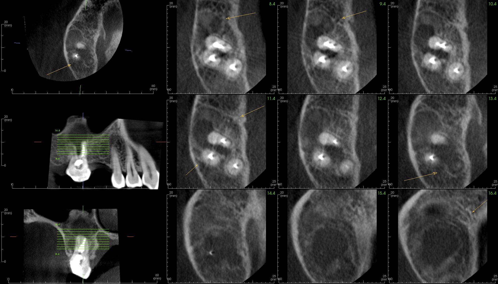 case-3.5-Endo-axial_3