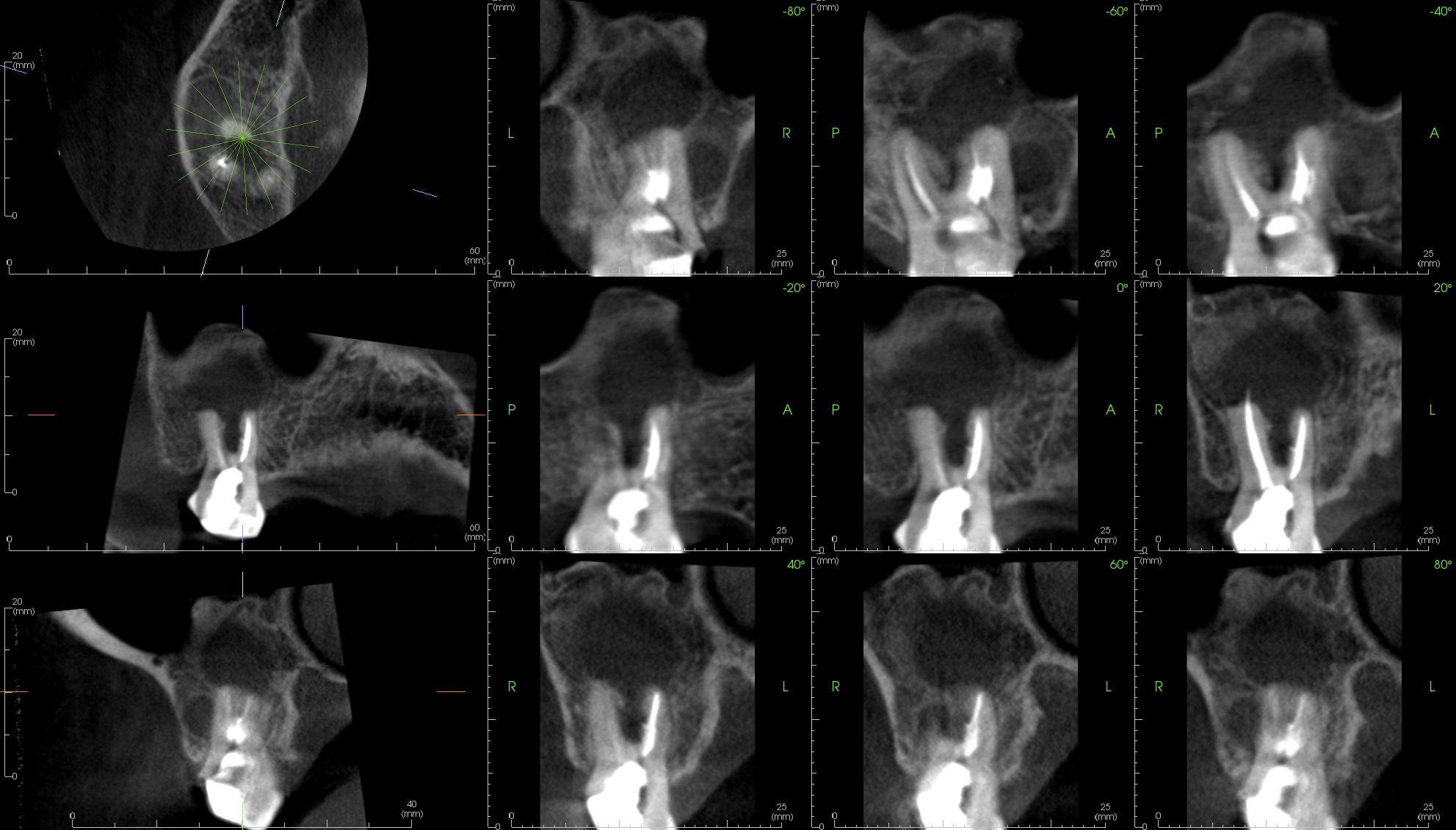 case-3.6-Endo-latera- views_3