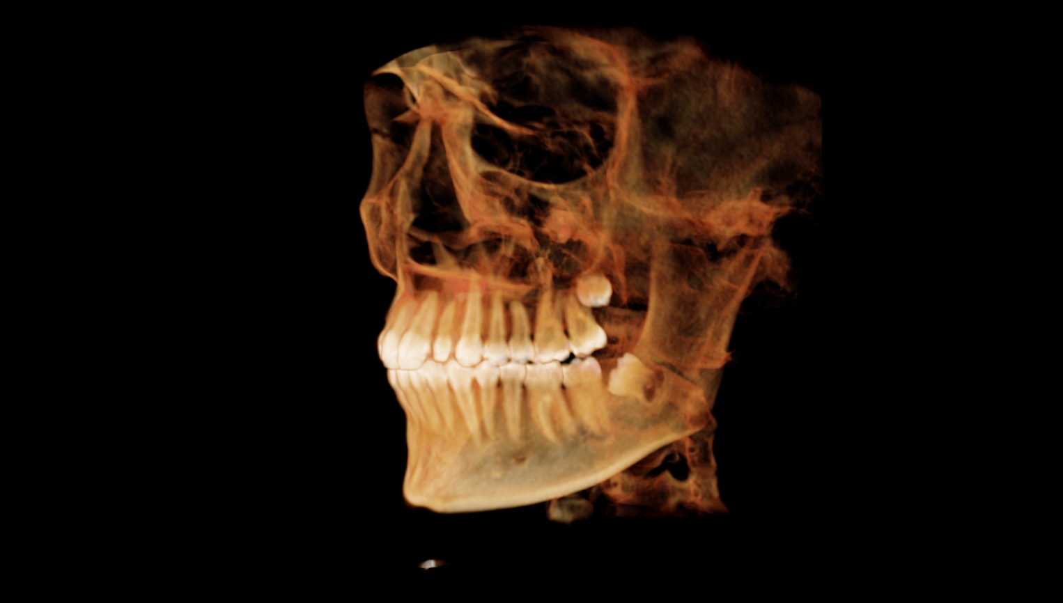 3d model-left parasagittal view