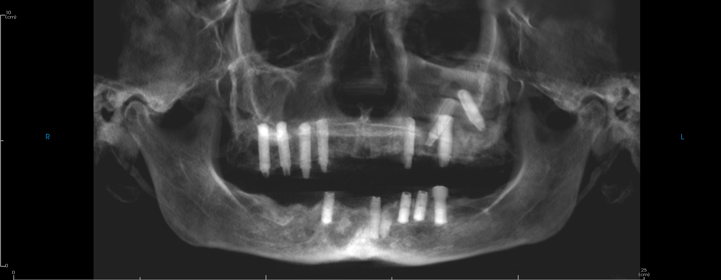 Pnaoramic-dental implant evaluation